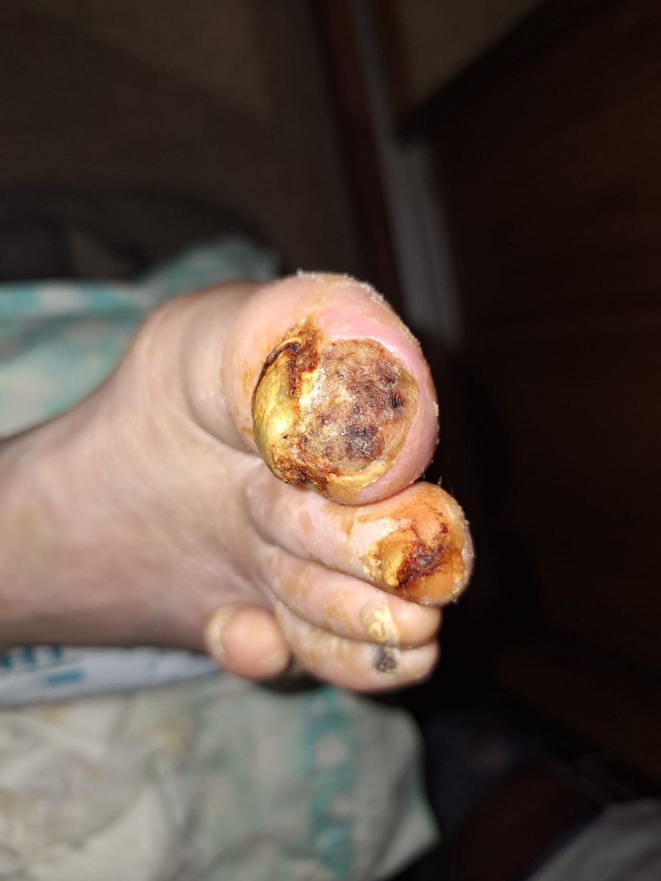 Diabetic foot syndrome