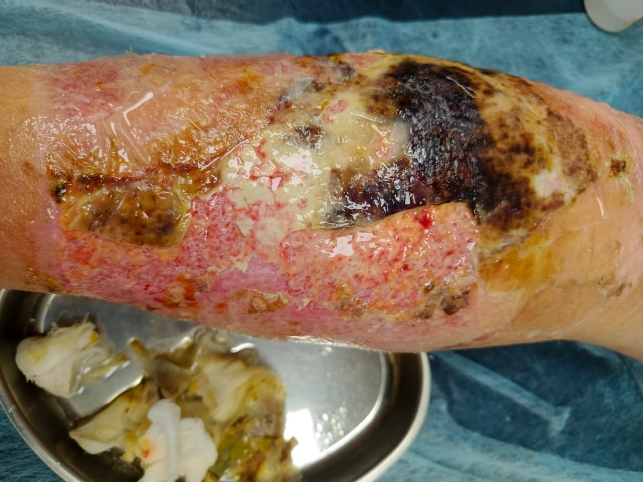 Thermal burn of the shin (grades II–III)