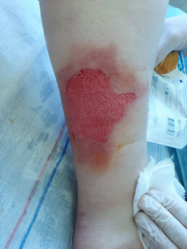 Thermal scald burn of the shin