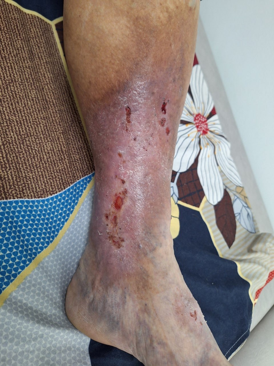 Trophic ulcers of the shin and foot