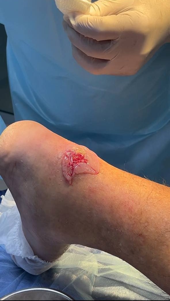 Trophic shin ulcer in an elderly patient