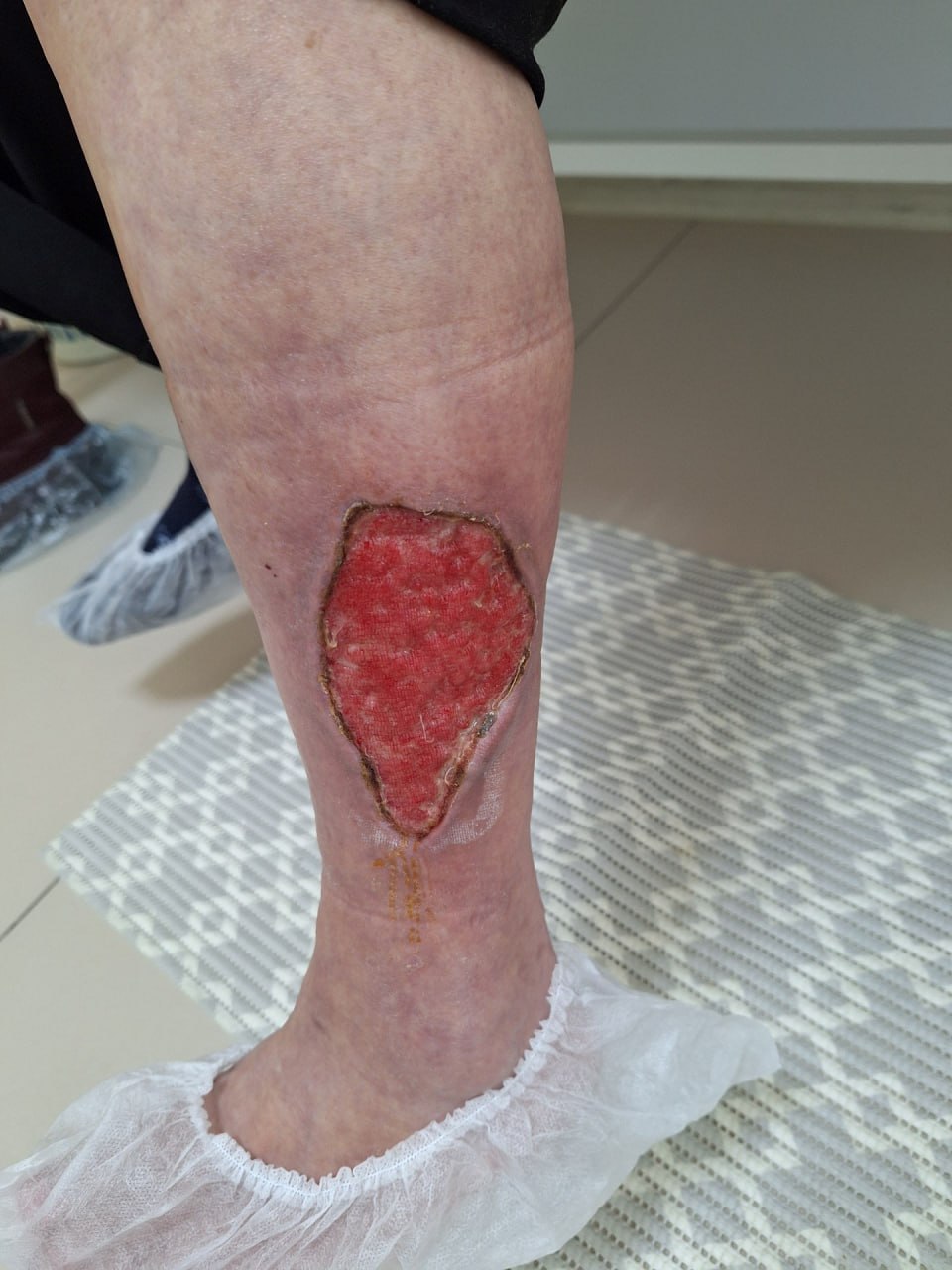 Degloving injury of the shin