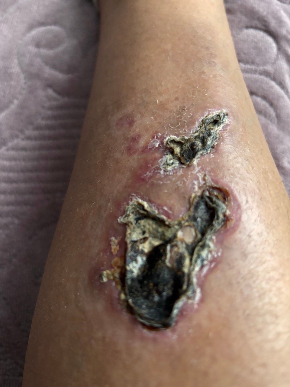 Crush wound with soft tissue necrosis